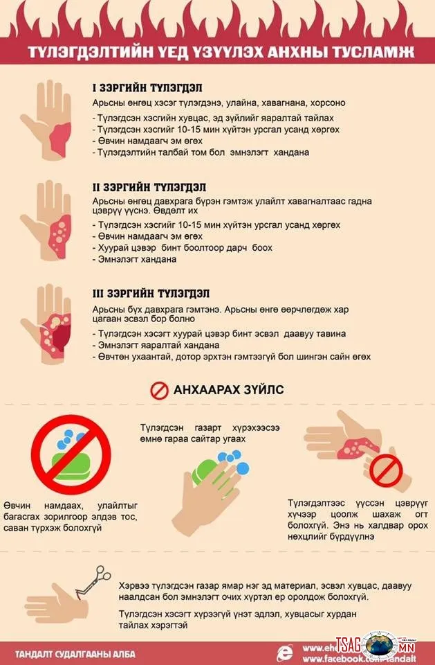ГССҮТ: Түлэгдэлтийн үед үзүүлэх анхны тусламж